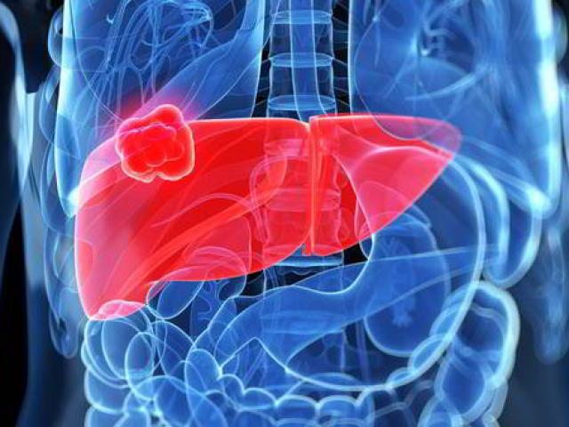 Sức khỏe đời sống - 3 dấu hiệu ở miệng giúp "tiên đoán" ung thư gan