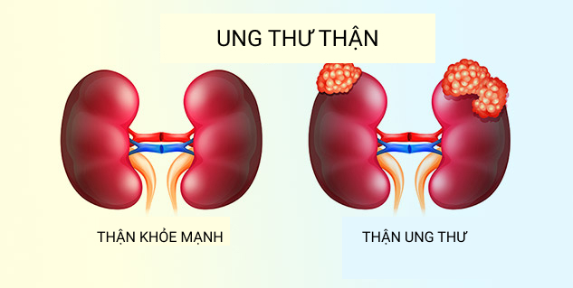 Khó tin: Người đàn ông sống sót khi chiến đấu với 4 căn bệnh ung thư trong vòng 5 năm - 1