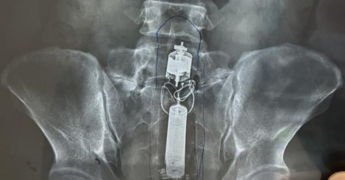 Sức khỏe đời sống - Giải cứu người đàn ông bị kẹt "của quý khủng" trong... hậu môn