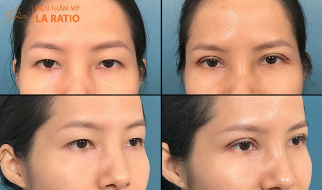 Mắt ngay sau khi thực hiện cắt mí iLid