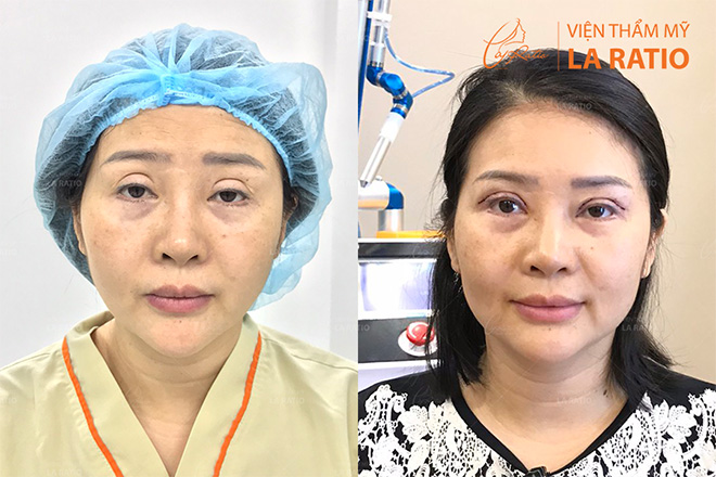 Một khách hàng đã phục hồi mí hỏng bằng phương pháp cắt mí iLid