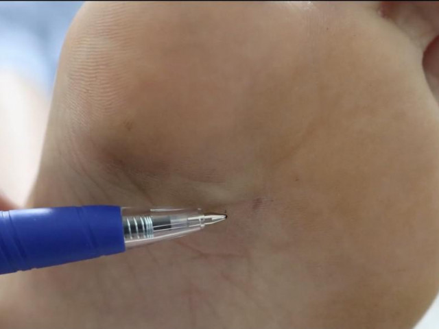 Sức khỏe đời sống - Thiếu nữ suýt mất mạng vì một vết ong đốt