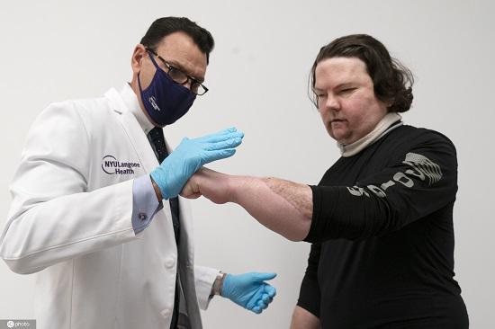 Khi đó, tất cả các ngón tay của Joe đều bị cắt cụt vì hoại tử, khuôn mặt thương nghiêm trọng, mất mí mắt và môi. Bác sĩ cho biết phẫu thuật thông thường không thể phục hồi khuôn mặt và bàn tay cho anh. Ảnh: Thời báo Hoàn Cầu