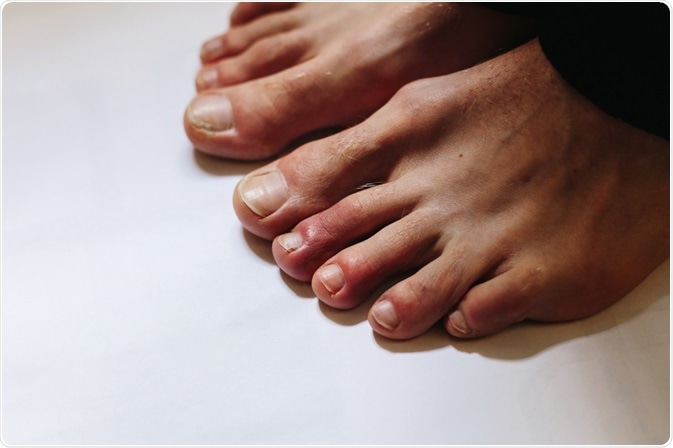 Ngón chân bất thường: Triệu chứng lạ cảnh báo nguy cơ mắc COVID-19 - 1