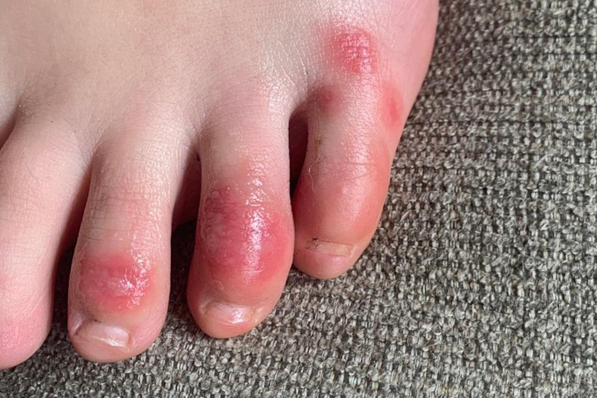 Ngón chân bất thường: Triệu chứng lạ cảnh báo nguy cơ mắc COVID-19 - 3