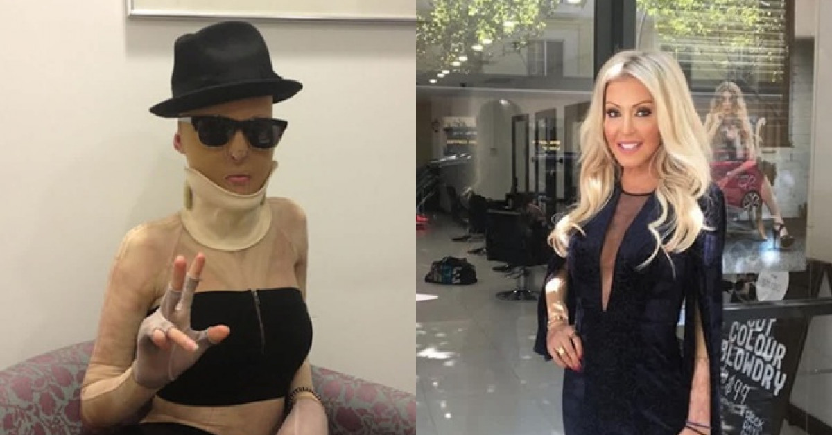 Bạn trẻ - Cuộc sống - Người phụ nữ bị đánh ghen, tạt axit đến mức hủy hoại dung nhan 9 năm trước giờ ra sao?