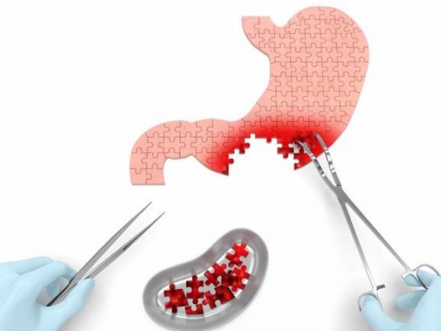 Sức khỏe đời sống - Bí quyết tránh xa ung thư dạ dày: Ăn ít "4 món" và không làm "3 việc"