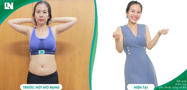 Chuyên gia tạo dáng Bác sĩ Lương Ngọc: Hút mỡ an toàn cần lưu ý gì? - 1