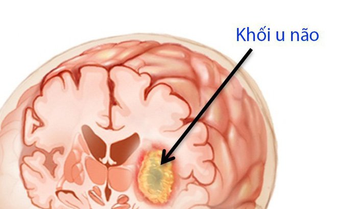 Diễn viên phim “Yêu tinh” qua đời vì ung thư não, dấu hiệu và biến chứng của căn bệnh này - 4