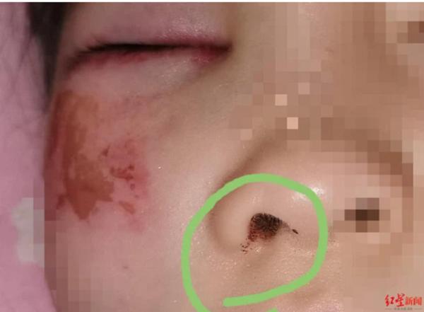 Bé gái 8 tuổi bị chấn thương ở vùng mặt.&nbsp;