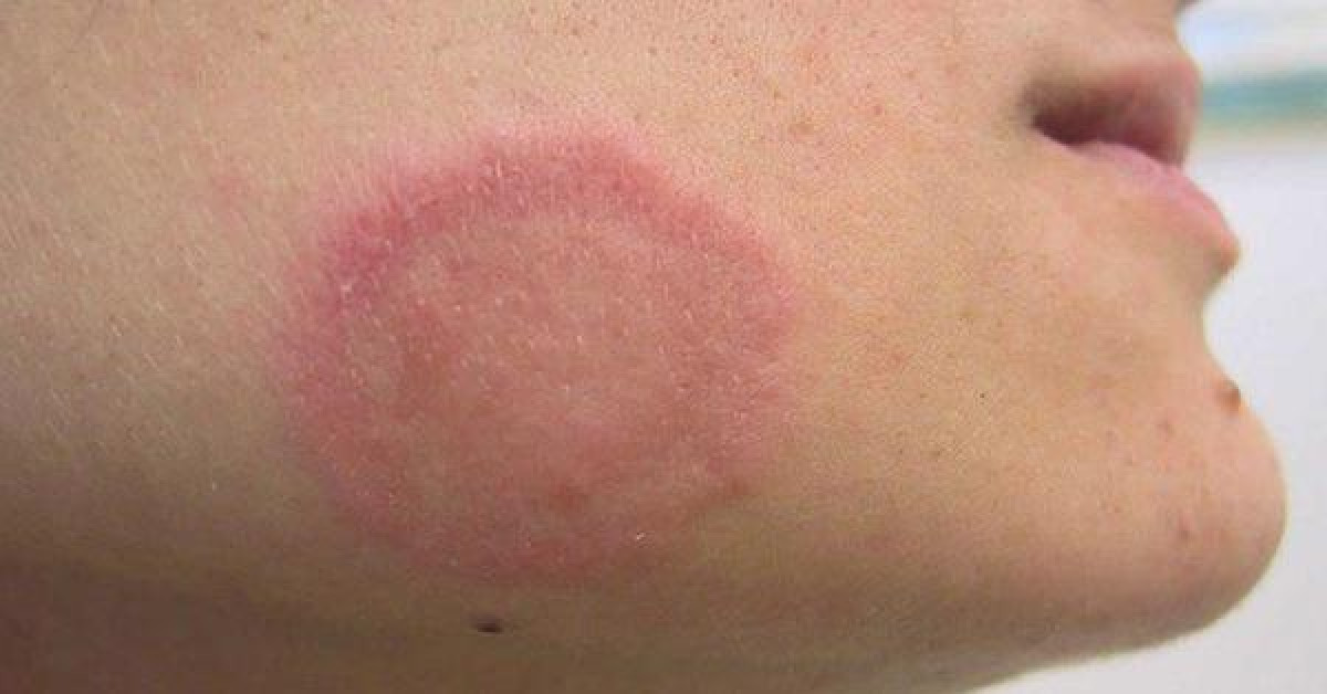 Sức khỏe đời sống - Căn bệnh da liễu khi trời nồm ẩm cao dễ mắc, chủ quan dẫn tới biến chứng khó lường