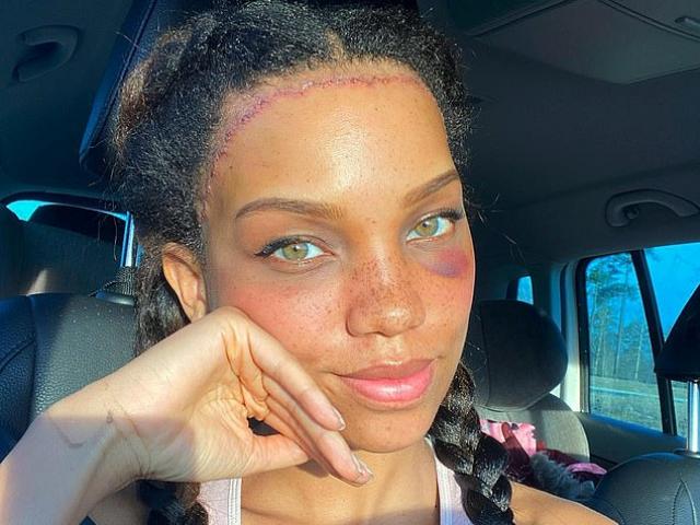 Bạn trẻ - Cuộc sống - Cô gái chi tiền khủng để phẫu thuật che giấu vầng trán “sân bay”