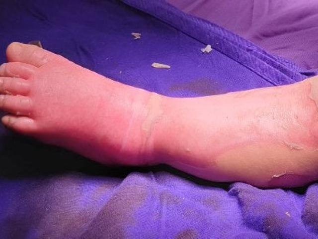 Sức khỏe đời sống - Bé 9 tháng tuổi tử vong vì gia đình đưa con đến thầy lang đắp thuốc chữa bỏng