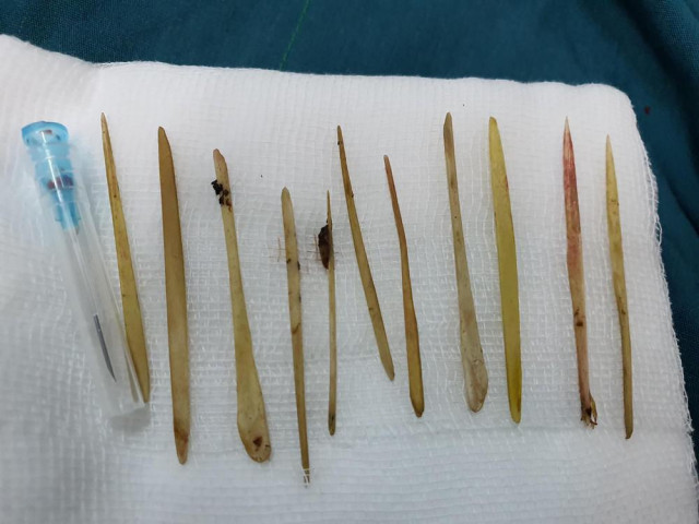 Sức khỏe đời sống - Người đàn ông bị thủng ruột vì ăn nhầm 11 chiếc tăm lúc nhậu say