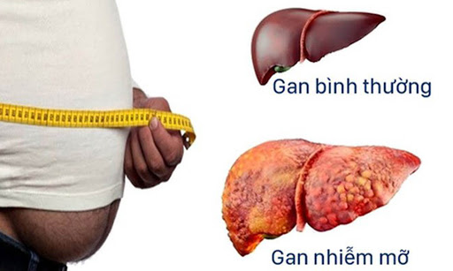 Quý ông bị gan nhiễm mỡ, nên làm gì để cải thiện chức năng gan? - 1