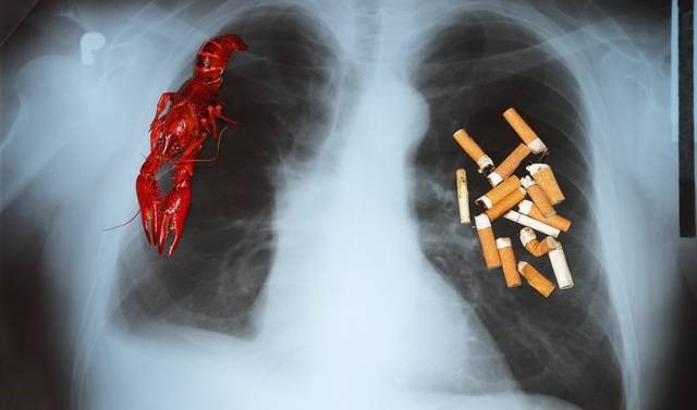 Huyền thoại bóng đá Paolo Rossi qua đời vì ung thư phổi, 4 dấu hiệu cần phát hiện sớm - 6