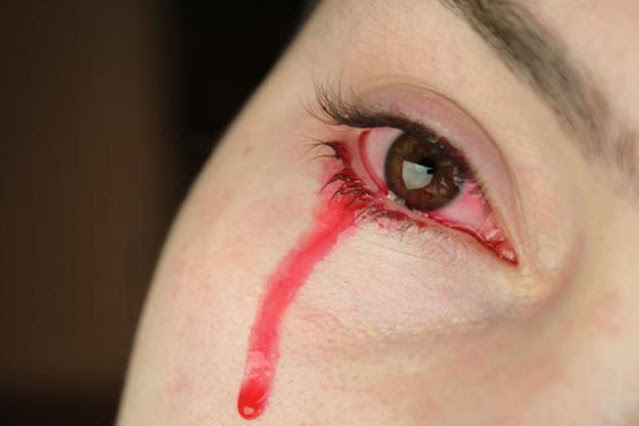 Tình trạng hiếm gặp khiến người phụ nữ “khóc ra máu” trong kỳ kinh nguyệt - 1