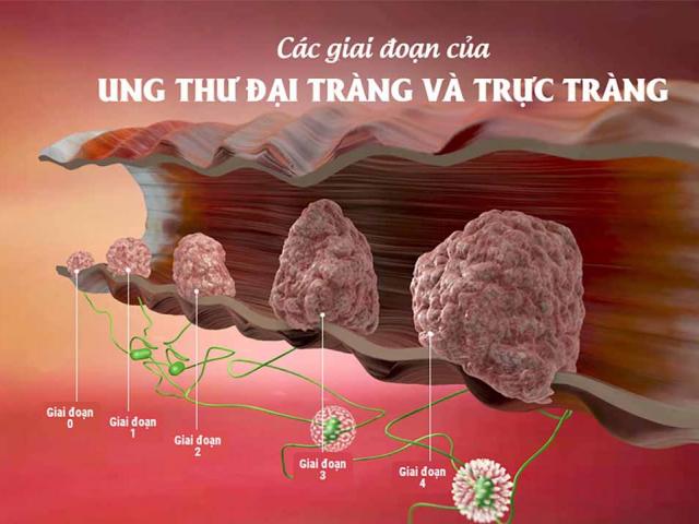 Ung thư đại trực tràng không còn là "tử thần" nếu ai cũng biết những điều này