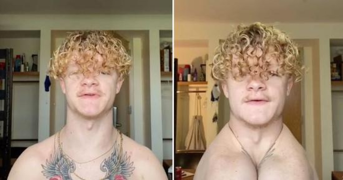 Thế giới - Thanh niên 24 tuổi không có xương quai xanh, có thể vỗ tay bằng hai vai