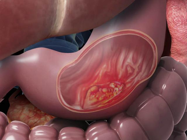 Sức khỏe đời sống - 9 thói quen hại dạ dày khủng khiếp, ai cũng mắc phải ít nhất 1 lỗi