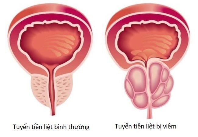 Tránh xa ung thư tuyến tiền liệt: Quý ông nên ít làm 4 "thứ", ăn nhiều 1 "món" - 1