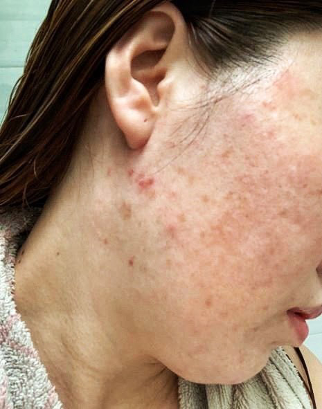 Một trong các biểu hiện của da khi nhiễm corticoid (Ảnh: ViSkin cung cấp)