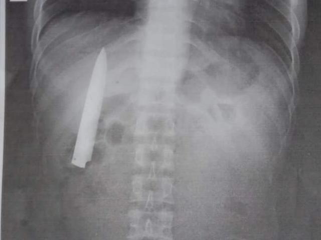 Sức khỏe đời sống - Tức ngực, đi khám, người đàn ông sốc khi thấy lưỡi dao nằm trong ngực