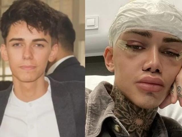 Bạn trẻ - Cuộc sống - Không hài lòng với gương mặt như soái ca, anh chàng chi "núi tiền" phẫu thuật để "dị hợm"