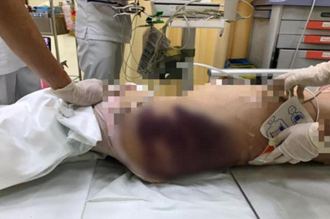 Những vết thương bầm tím trên cơ thể của bé Vân An