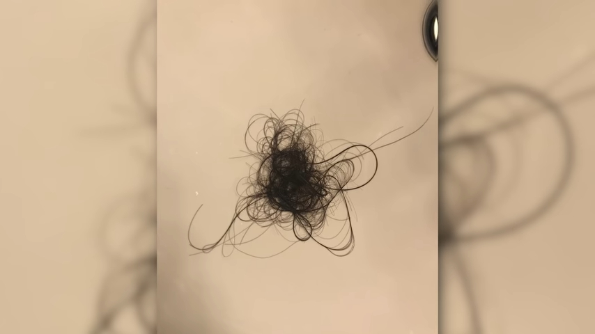 Phương Mỹ Chi lộ hình ảnh gây sốc: Tay bầm tím, rụng tóc nghiêm trọng ở tuổi 18 - 8