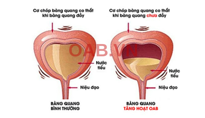 Cảnh báo rối loạn chức năng bàng quang do tiểu đêm, tiểu nhiều lần - Tuyệt đối không được chủ quan với những dấu hiệu này - 1