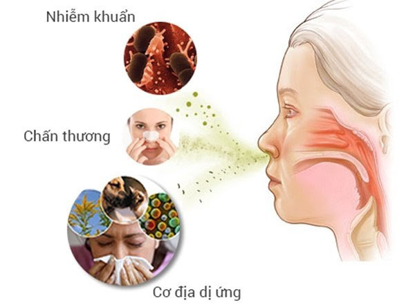 Bệnh viêm mũi do nhiều yếu tố gây ra