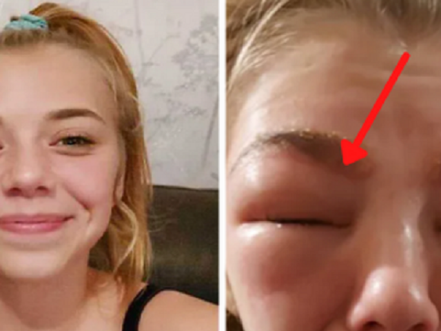 Sức khỏe đời sống - Thiếu nữ khóc ngất vì mắt sưng húp, chảy dịch sau khi nhuộm lông mày, nối mi