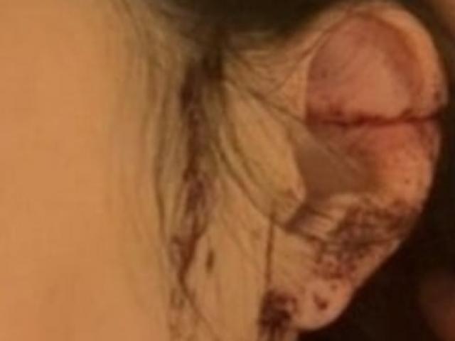 Thế giới - Hàn Quốc: Cô gái tới hộp đêm uống rượu, tỉnh dậy ở nhà thấy một bên tai bị cắt rời