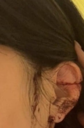 Vết thương ở bên tai trái của cô gái.
