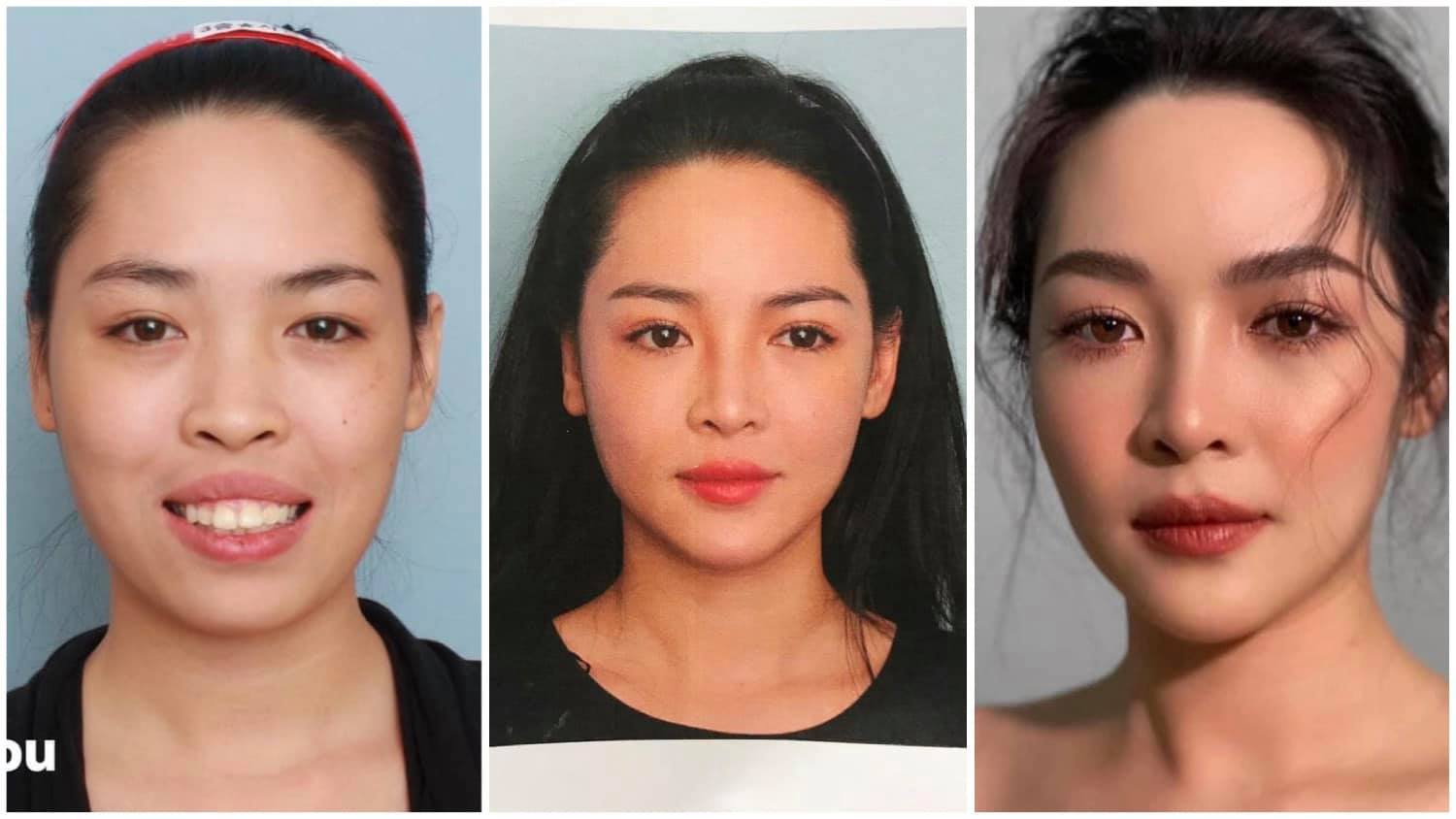 Cô từng trải qua nhiều cuộc phẫu thuật để thay đổi khuyết điểm trên gương mặt.