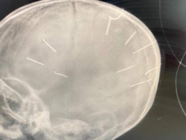 Tin tức trong ngày - Tin tức 24h qua: Công an làm việc với bạn trai của mẹ bé gái 3 tuổi nghi bị đinh găm vào đầu