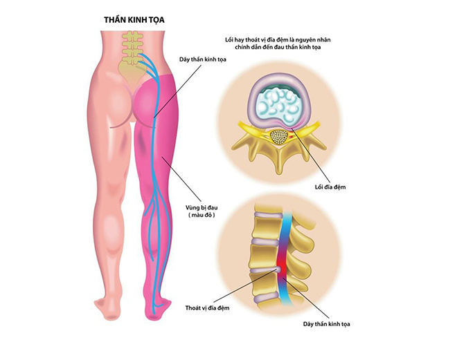Chia sẻ thực phẩm chức năng dùng cho người bị đau thần kinh tọa - 1