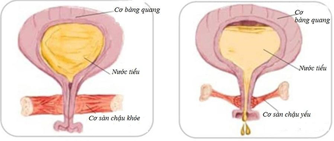 Hình ảnh cơ sàn chậu của phụ nữ bị suy yếu