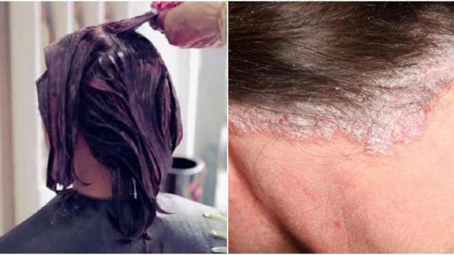 Những lưu ý tránh tóc "ướp hóa chất" rụng cả mảng, sưng tấy da đầu khi làm đẹp đón Tết - 3