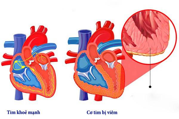 Viêm cơ tim là một bệnh viêm nhiễm của tim.