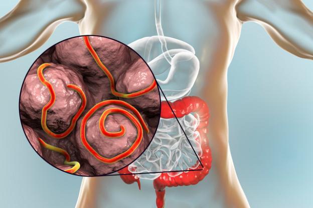 Một số bệnh giun sán hay gặp ở trẻ em: Nhận biết và cách phòng ngừa - 4