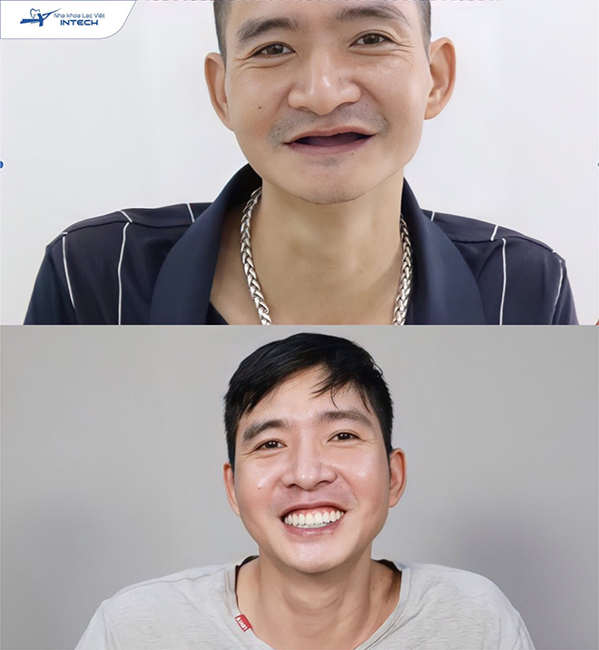 Anh Đặng Sơn Hải sau khi trồng răng Implant