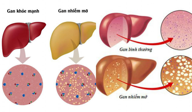 Gan nhiễm mỡ thường có 4 điểm chung này, chị em đừng nghĩ mình gầy mà chủ quan - 1