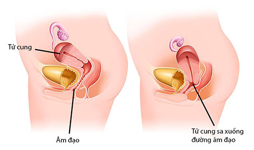 Hình ảnh tử cung (ở bên phải) bị sa xuống âm đạo