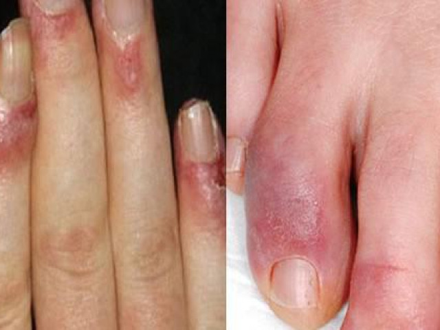 Sức khỏe đời sống - Chuyên gia bày cách khắc phục căn bệnh được coi là nỗi "ám ảnh" của nhiều người trong thời tiết rét buốt