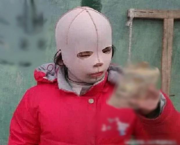 Bé gái 10 tuổi luôn đeo mũ trùm kín mặt khi đi học, nguyên nhân khiến ai nấy không khỏi xót xa.&nbsp;