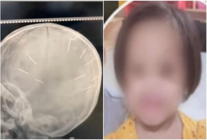 Hình ảnh 9 chiếc đinh trong đầu bé A.