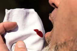 Sức khỏe đời sống - Ho ra máu có phải bị ung thư: Cách nhận biết và những lưu ý