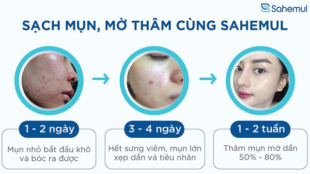 Sahemul - kem bôi ngừa mụn trứng cá và thâm mụn kéo dài - 4